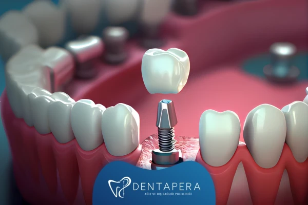 Bir Günde Kaç İmplant Yapılabilir? | Denta Pera