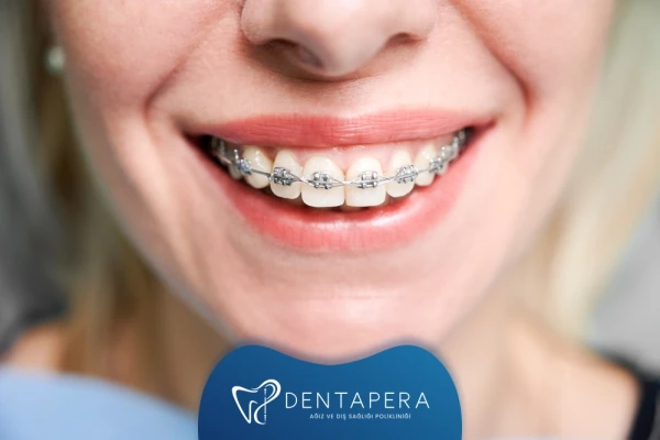 Diş Teli Kullanımında Sık Yapılan Hatalar ve Bunlardan Kaçınmanın Yolları | Denta Pera