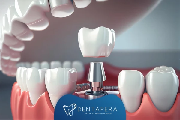 En İyi İmplant Markaları Nelerdir? | Denta Pera