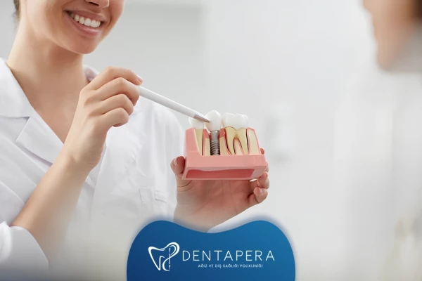 İmplant Fiyatları Neye Göre Değişir? | Denta Pera