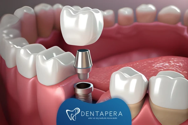 İmplant Tedavisi Adımları ve Süreci Nasıl İlerler? | Denta Pera