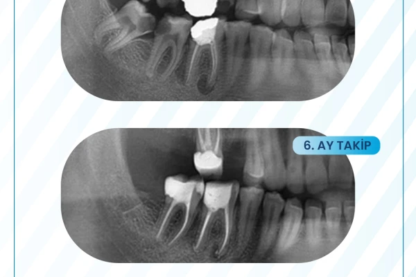 Kanal Yenileme İşlemi Nedir? | Denta Pera